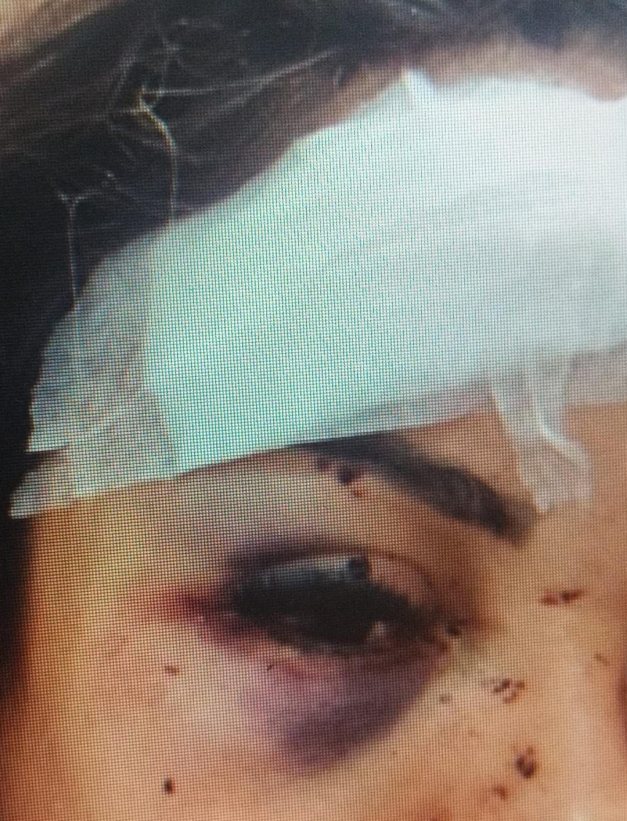 Veja como ficou o rosto da mulher torturada em cárcere privado pelo ex em Valparaíso.