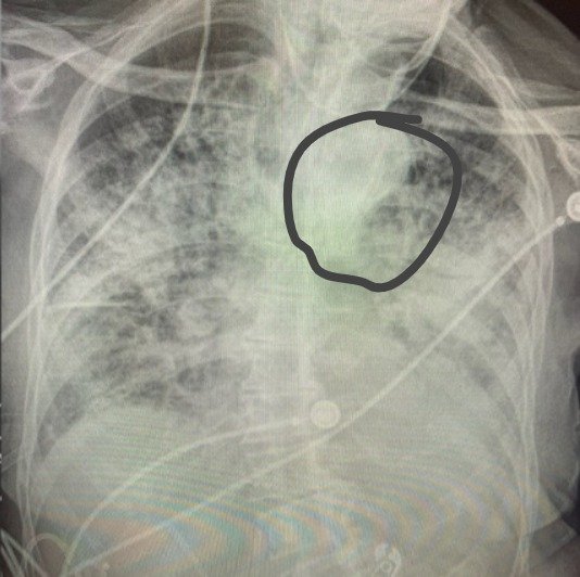 Mulher dá entrada no hospital com suspeita de “tuberculose” e descobre camisinha no pulmão